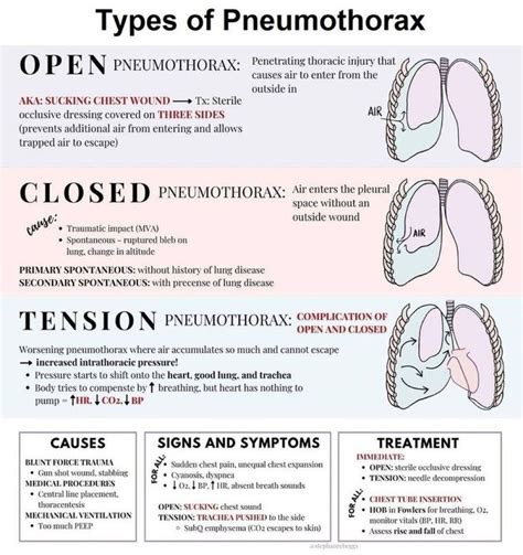 Caduceus Em And Critical Care Foam ️types Of Pneumothorax