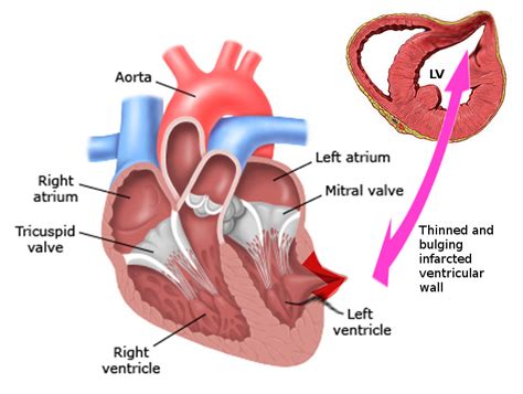 [Figure, Left Ventricular Pseudoaneurysm Contributed by S Bhimji, MD ...