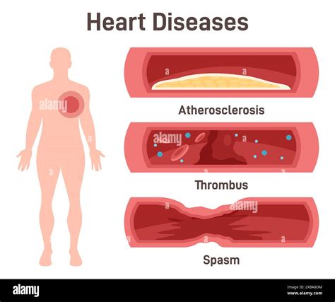 Heart Diseases Atherosclerosis Thrombus Coronary Artery Spasm