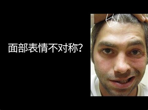 贝尔面瘫Bell Palsy YouTube