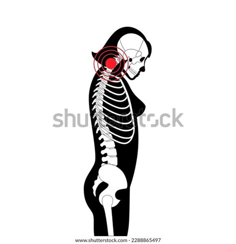 Diagram Deformation Cervical Vertebrae Neck Spasm Stock Vector Royalty