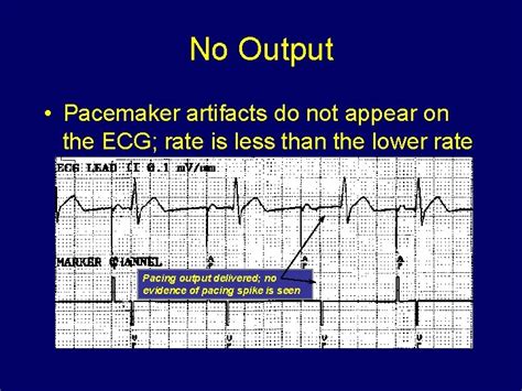 Ecg In Pacemaker Malfunction Sriram Rajagopal Southern Railway