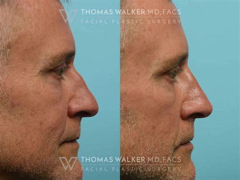 Liquid Rhinoplasty Before And After Photos Atlanta Ga