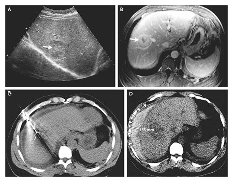 Case 38 2008 A 58 Year Old Man With Hemophilia Hepatocellular