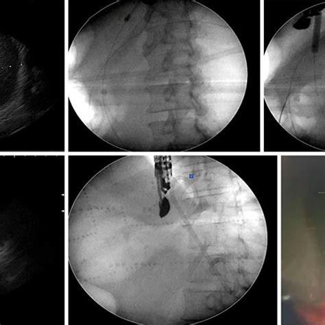 A F Steps For Eus Guided Cystogastrostomy Download Scientific Diagram