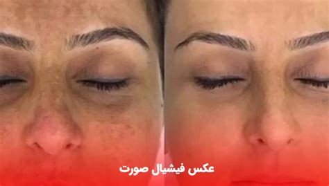 فیشیال صورت چیست هزینه فیشیال صورت مزایا، عوارض، مراحل و تعداد