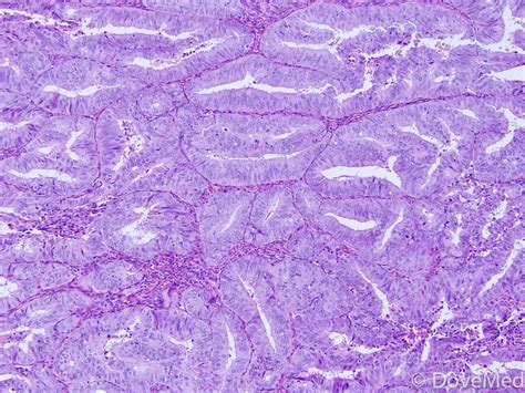 Lepidic Adenocarcinoma Of Lung Dovemed