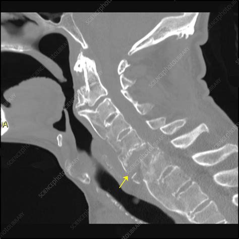 Chance Fracture And Dish Stock Image C0271717 Science Photo Library