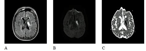 Actualización en diagnóstico y tratamiento del ataque cerebrovascular