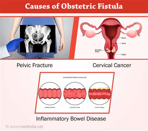 Obstetric Fistula Causes Symptoms Diagnosis Treatment Prevention