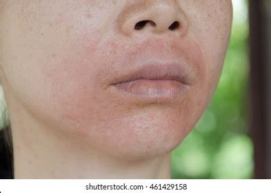 Human Skin Presenting Allergic Reaction Allergic Stock Photo 461429158