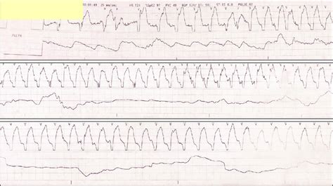 Electrocardiogram Showing Ventricular Tachycardia Download