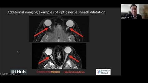 Iih Mri Showing Flattening Of Posterior Globes And Distal Optic Nerve