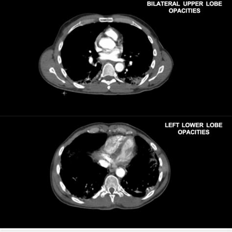 Chest X Ray Cxr One Day Post Admission Demonstrating