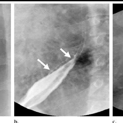 (PDF) Esophageal Varices: Evaluation with Esophagography with Barium ...