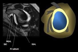 Inferior Glenohumeral Ligament Mri