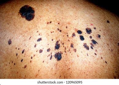 1 771 Pigmented Skin Lesion Images Stock Photos 3D Objects Vectors