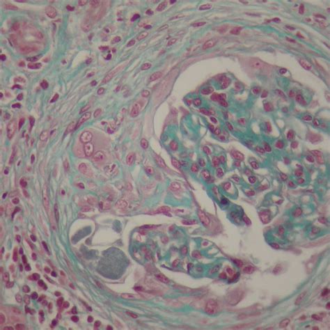 Renal Biopsy ×400 Fibrocellular Crescent In A Glomerulus