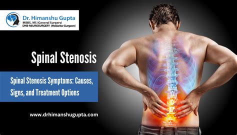 Understanding Spinal Stenosis Symptoms Causes Signs And Treatment