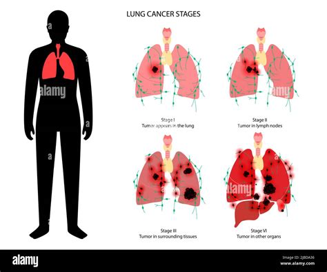 Lungs cancer stages, illustration Stock Photo - Alamy