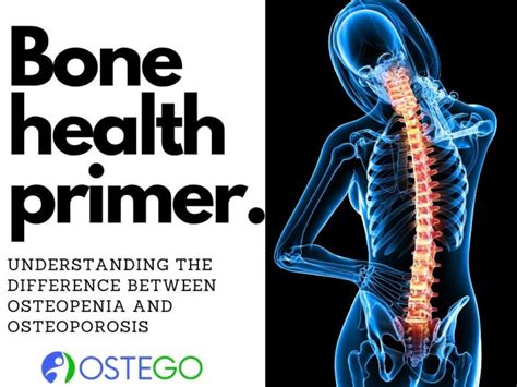 Osteoporosis And Osteopenia Know The Difference Now Ostego