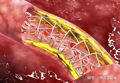 国内将逐渐停止心脏支架手术做完人就废了医生说出大实话 知乎