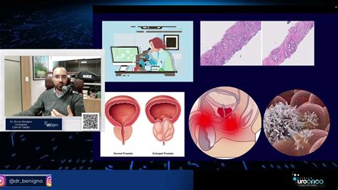 O Que é A Escala De Gleason Para O Câncer De Próstata Youtube