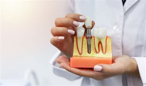 Tips For Properly Maintaining Your Dental Implants