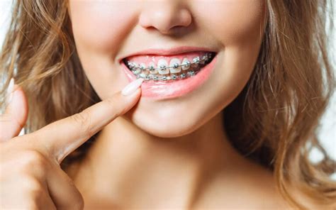 What To Expect Affordable Braces And Invisalign In Melbourne