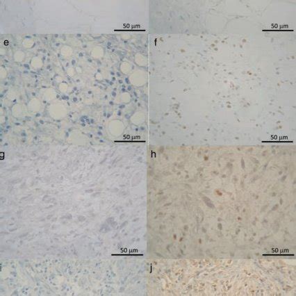 Immunohistochemical Expression Of Ppar In Lipoma B Wdls D M Rls