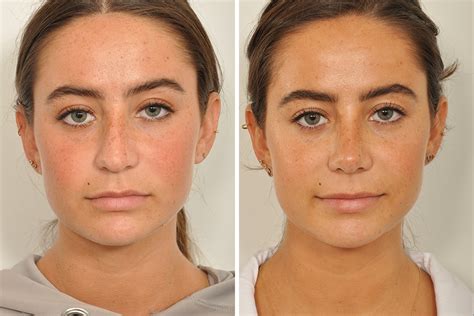 Rhinoplasty Nose Surgery Nose Job For Women In New York City David