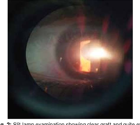 Figure 2 From Management Of Acanthamoeba And Candida Keratitis In A Young Female Our Experience