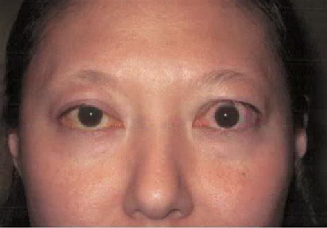 Thyroid Eye Disease Photos Thyroid Eye Disease Diseases Club Center 2