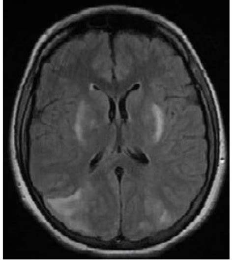 Coupe Irm C R Brale T Flair Hypersignal T Cortico Sous Cortical