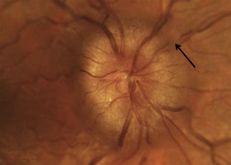 Grade 3 papilledema is characterized by loss of major vessels as they ...