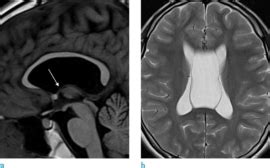 Fornix Mri