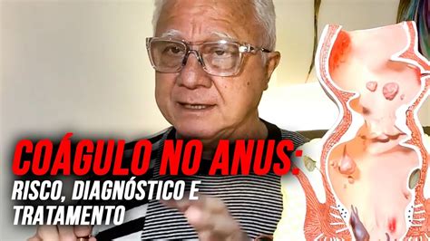 Bolinha dura ou coágulo no anus Sintomas diagnóstico e tratamento