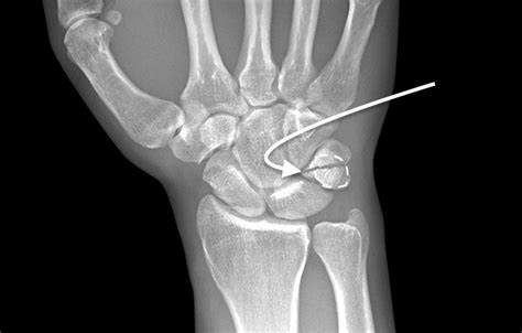 TRIQUETRUM FRACTURES | Hand Surgery Resource