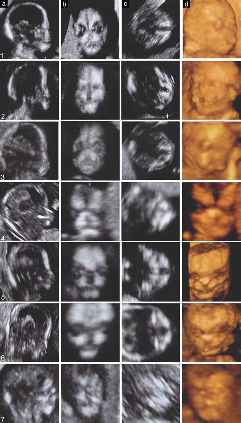 Firsttrimester Diagnosis Of Cleft Lip And Palate Using Three