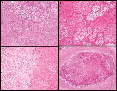 Caseous Necrosis Histology