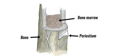 Periosteal Contusion (Bone Bruise) - Symptoms, Causes & Treatment