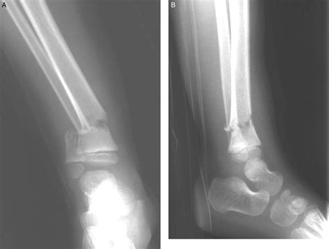 Dislocation Of The Proximal And Distal Tibiofibular Off