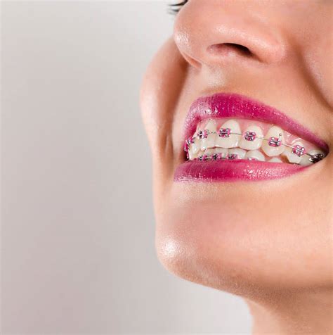 key benefits  braces treatment peak orthodontics