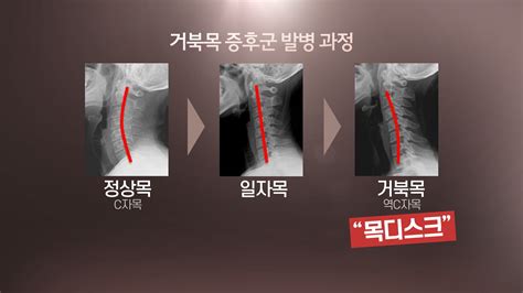 목 디스크 부르는 거북목 증후군예방법은 연합뉴스