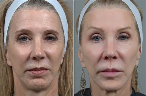 CO2 Laser Skin Resurfacing in Birmingham, AL | Seiler Skin