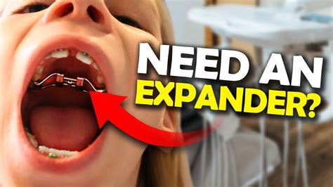 Getting A Palatal Expander What You Need To Know Mckinney