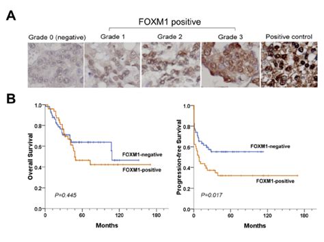 Foxm1 Expression Correlates With Tumor Progression And Patient