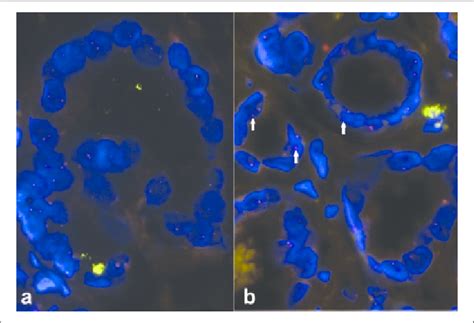 FISH Break Apart Assay For TMPRSS2 ERG A Carcinoma Expressing P63