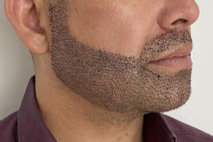 Transplante De Barba Como Funciona E Quais Suas Vantagens