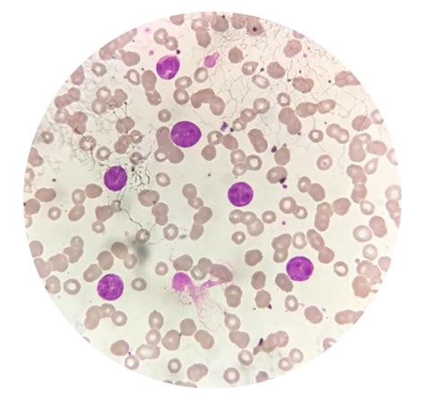 Células de leucemia mieloide crónica o lmc analizadas al microscopio